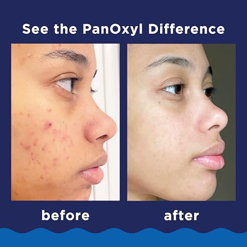 PanOxyl Acne Foaming Wash Benzoyl Peroxide 10% Maximum Strength Antimicrobial, 5.5 Oz-UPStoxs